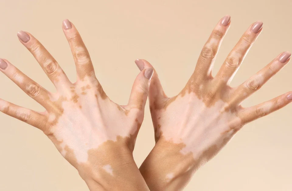 What is vitiligo, vitiligo treatment, vitiligo causes, vitiligo types