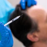 Exosome hair injections: The most suitable non-surgical procedure for your hair