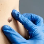 Laser Mole Removal: The Latest Cosmetics Technology