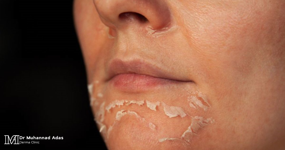 When Does the Effect of Chemical Peeling for the Face Start?